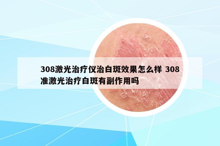 308激光治療儀治白斑效果怎么樣 308準(zhǔn)激光治療白斑有副作用嗎