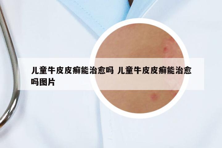 兒童牛皮皮癬能治愈嗎 兒童牛皮皮癬能治愈嗎圖片