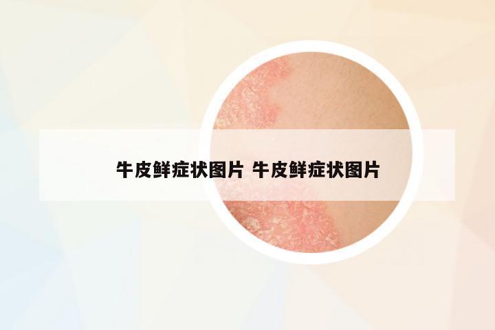 牛皮鮮癥狀圖片 牛皮鮮癥狀圖片