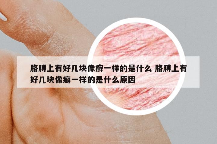 胳膊上有好幾塊像癬一樣的是什么 胳膊上有好幾塊像癬一樣的是什么原因