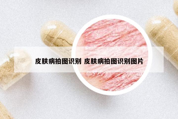 皮膚病拍圖識別 皮膚病拍圖識別圖片