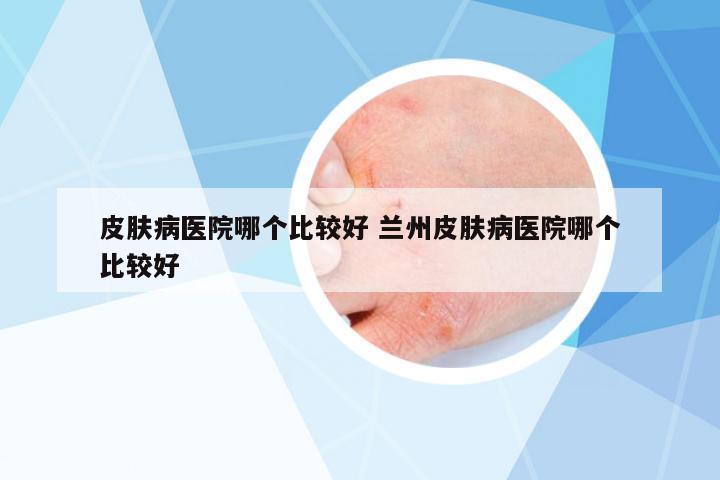 皮膚病醫(yī)院哪個(gè)比較好 蘭州皮膚病醫(yī)院哪個(gè)比較好