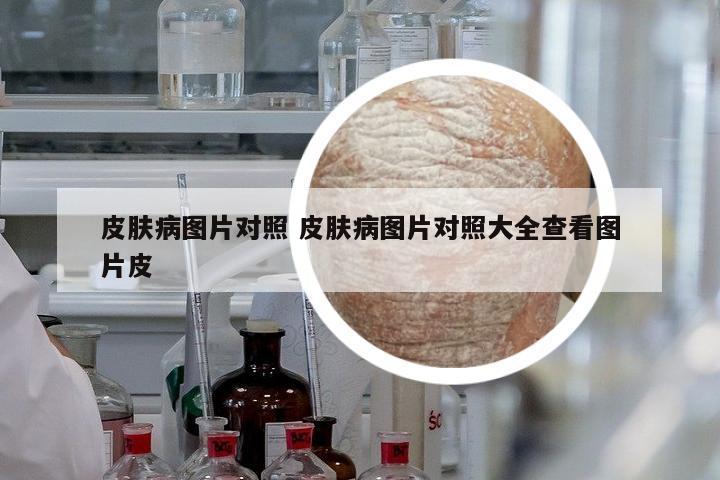 皮膚病圖片對(duì)照 皮膚病圖片對(duì)照大全查看圖片皮