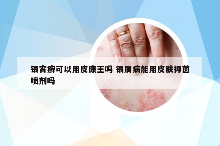 銀宵癬可以用皮康王嗎 銀屑病能用皮膚抑菌噴劑嗎