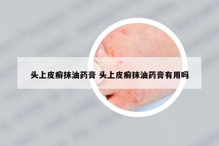 頭上皮癬抹油藥膏 頭上皮癬抹油藥膏有用嗎