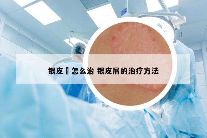 銀皮廯怎么治 銀皮屑的治療方法