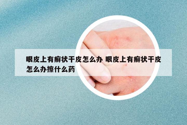眼皮上有癬狀干皮怎么辦 眼皮上有癬狀干皮怎么辦擦什么藥