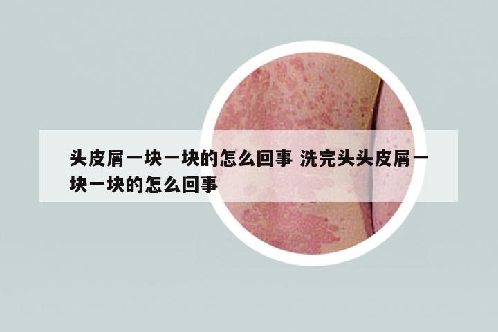 頭皮屑一塊一塊的怎么回事 洗完頭頭皮屑一塊一塊的怎么回事