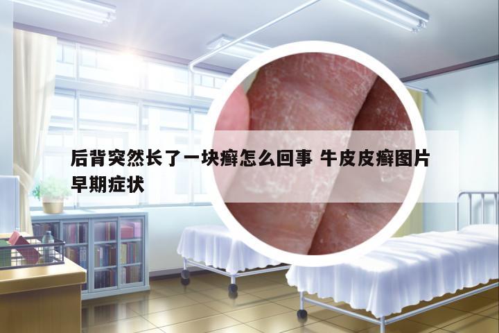 后背突然長了一塊癬怎么回事 牛皮皮癬圖片早期癥狀