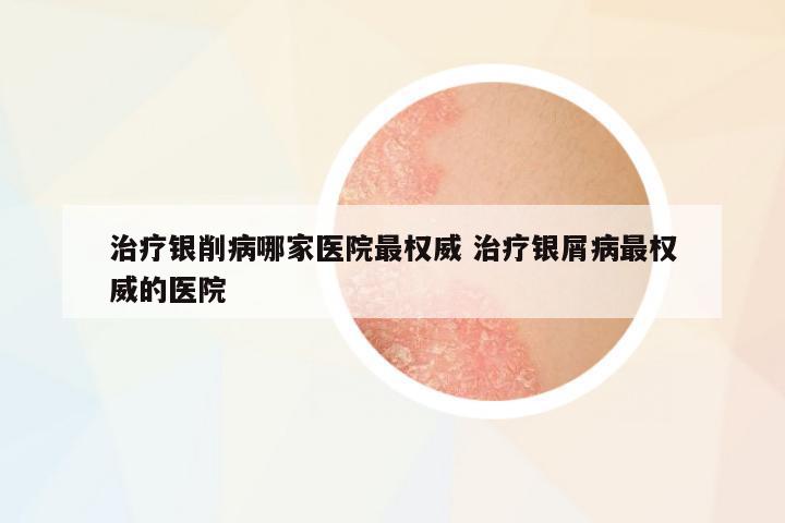 治療銀削病哪家醫(yī)院最權(quán)威 治療銀屑病最權(quán)威的醫(yī)院