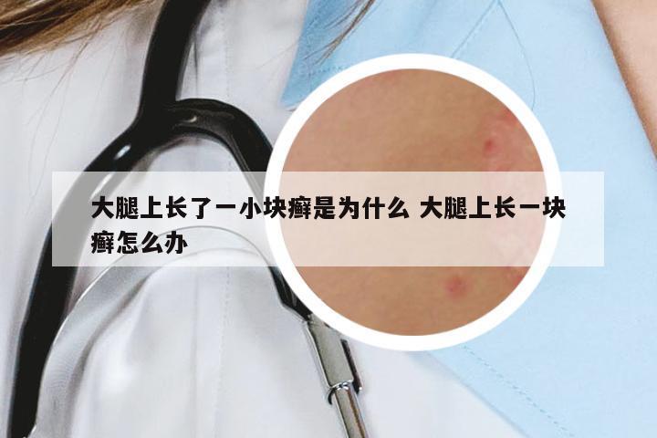 大腿上長了一小塊癬是為什么 大腿上長一塊癬怎么辦