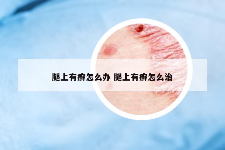 腿上有癬怎么辦 腿上有癬怎么治