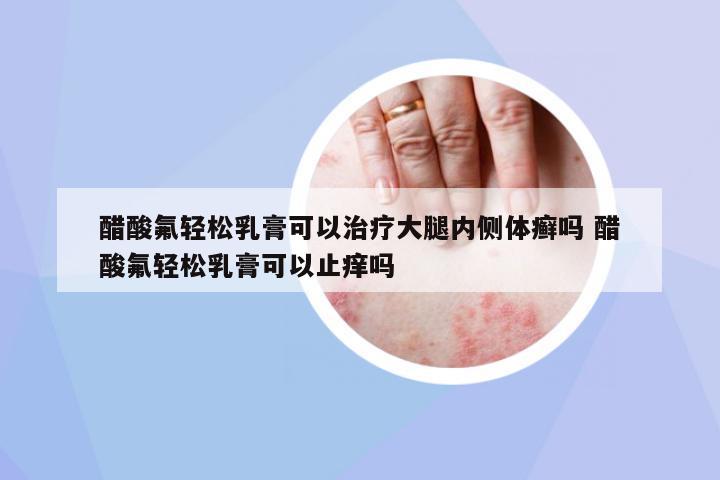 醋酸氟輕松乳膏可以治療大腿內(nèi)側(cè)體癬嗎 醋酸氟輕松乳膏可以止癢嗎