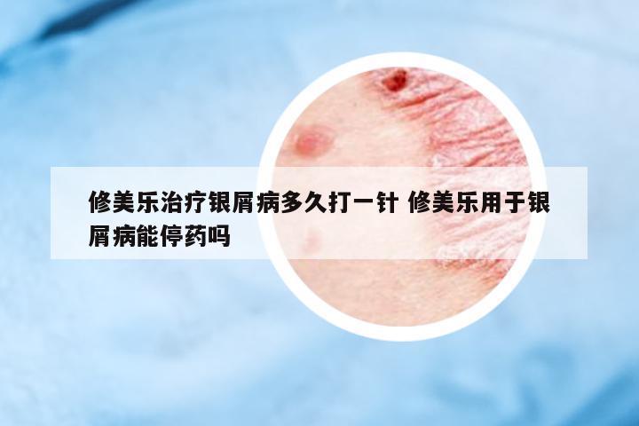 修美樂治療銀屑病多久打一針 修美樂用于銀屑病能停藥嗎
