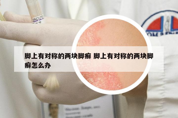 腳上有對(duì)稱的兩塊腳癬 腳上有對(duì)稱的兩塊腳癬怎么辦