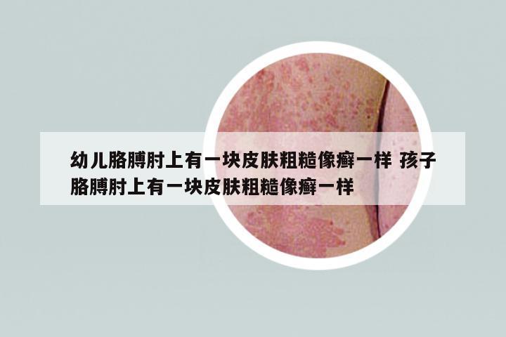 幼兒胳膊肘上有一塊皮膚粗糙像癬一樣 孩子胳膊肘上有一塊皮膚粗糙像癬一樣