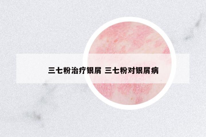三七粉治療銀屑 三七粉對銀屑病