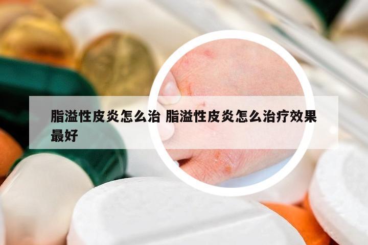脂溢性皮炎怎么治 脂溢性皮炎怎么治療效果最好