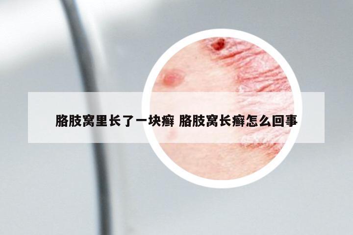 胳肢窩里長了一塊癬 胳肢窩長癬怎么回事