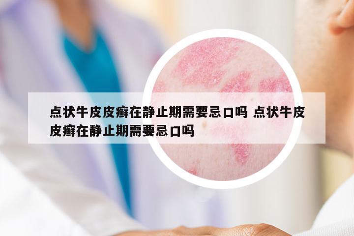 點(diǎn)狀牛皮皮癬在靜止期需要忌口嗎 點(diǎn)狀牛皮皮癬在靜止期需要忌口嗎
