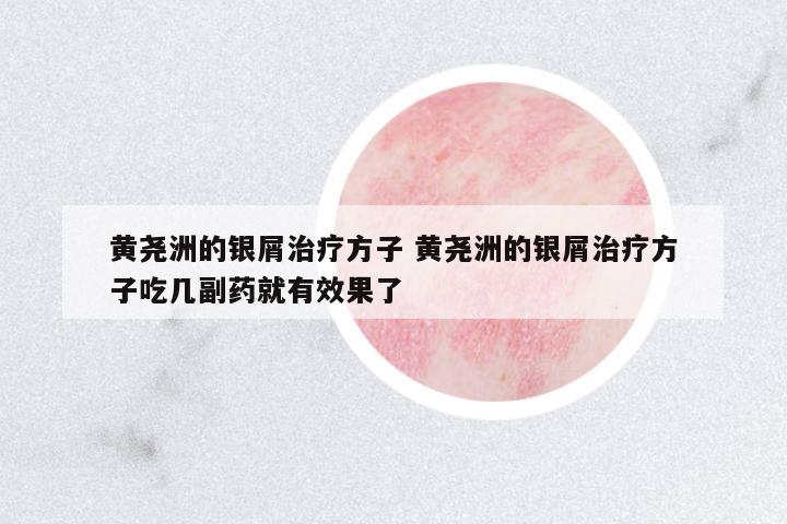 黃堯洲的銀屑治療方子 黃堯洲的銀屑治療方子吃幾副藥就有效果了