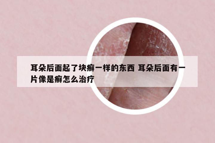 耳朵后面起了塊癬一樣的東西 耳朵后面有一片像是癬怎么治療