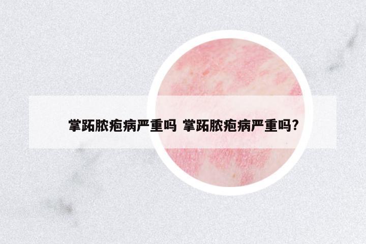 掌跖膿皰病嚴(yán)重嗎 掌跖膿皰病嚴(yán)重嗎?