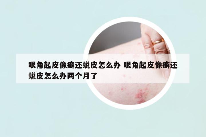 眼角起皮像癬還蛻皮怎么辦 眼角起皮像癬還蛻皮怎么辦兩個(gè)月了
