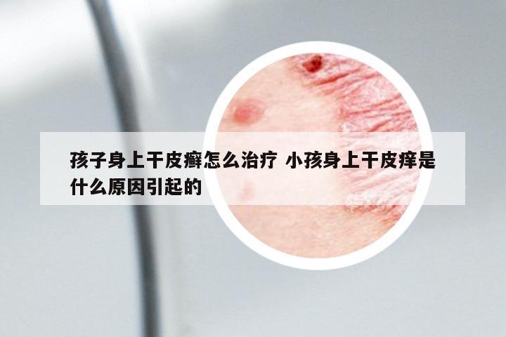孩子身上干皮癬怎么治療 小孩身上干皮癢是什么原因引起的