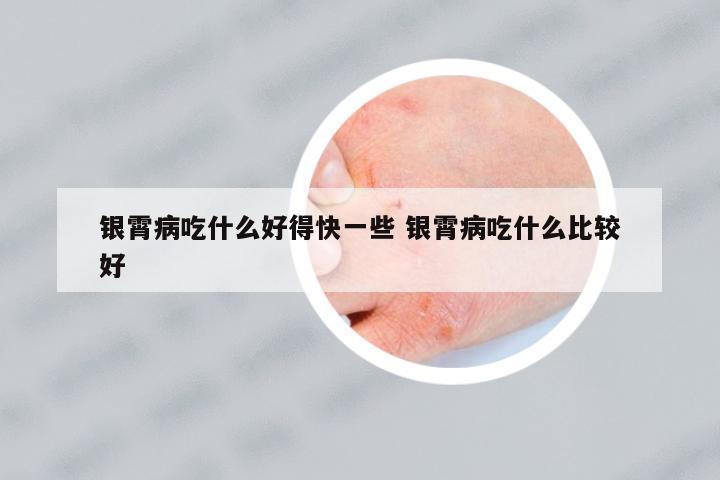 銀霄病吃什么好得快一些 銀霄病吃什么比較好