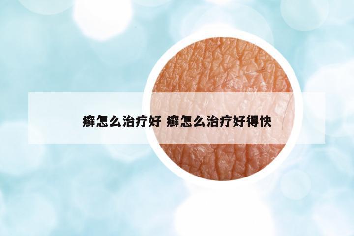 癬怎么治療好 癬怎么治療好得快