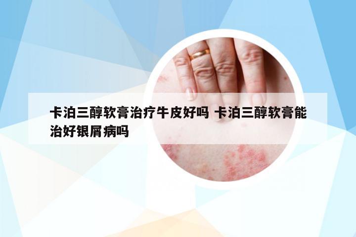卡泊三醇軟膏治療牛皮好嗎 卡泊三醇軟膏能治好銀屑病嗎