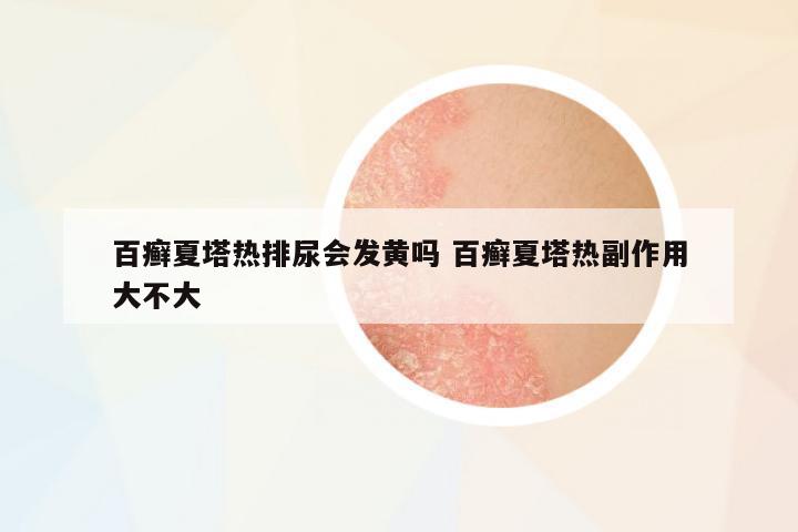 百癬夏塔熱排尿會(huì)發(fā)黃嗎 百癬夏塔熱副作用大不大