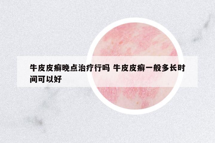 牛皮皮癬晚點(diǎn)治療行嗎 牛皮皮癬一般多長(zhǎng)時(shí)間可以好