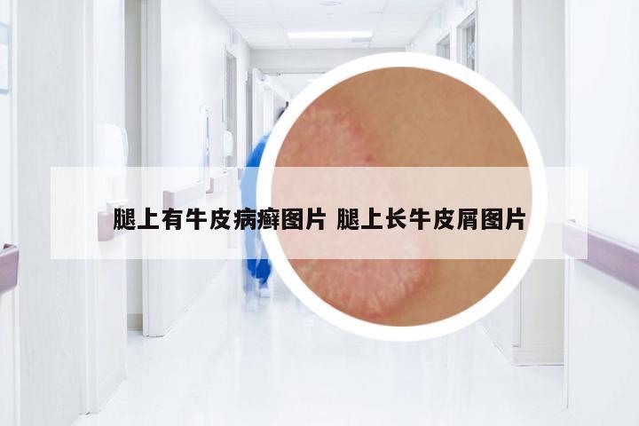 腿上有牛皮病癬圖片 腿上長牛皮屑圖片