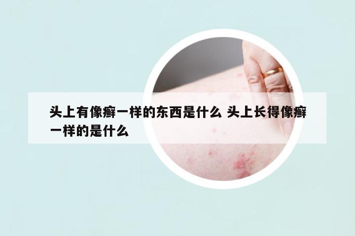 頭上有像癬一樣的東西是什么 頭上長得像癬一樣的是什么