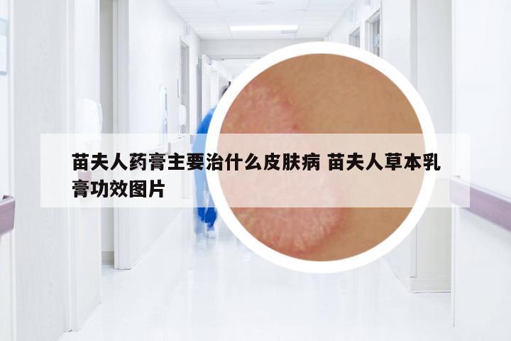 苗夫人藥膏主要治什么皮膚病 苗夫人草本乳膏功效圖片