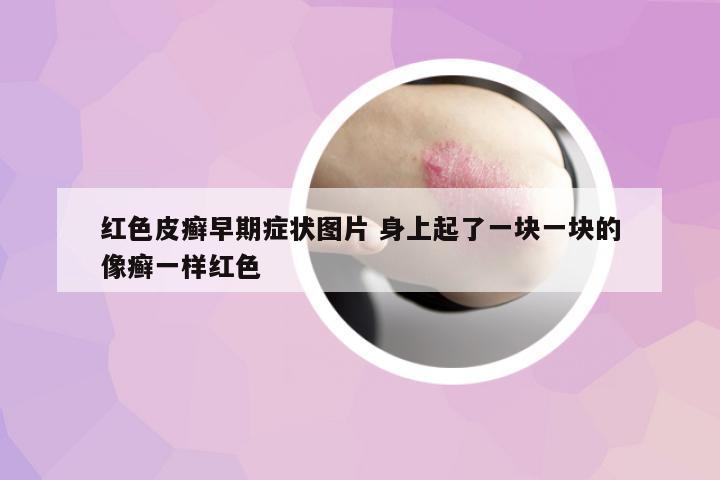 紅色皮癬早期癥狀圖片 身上起了一塊一塊的像癬一樣紅色