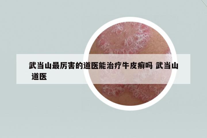 武當(dāng)山最厲害的道醫(yī)能治療牛皮癬嗎 武當(dāng)山 道醫(yī)