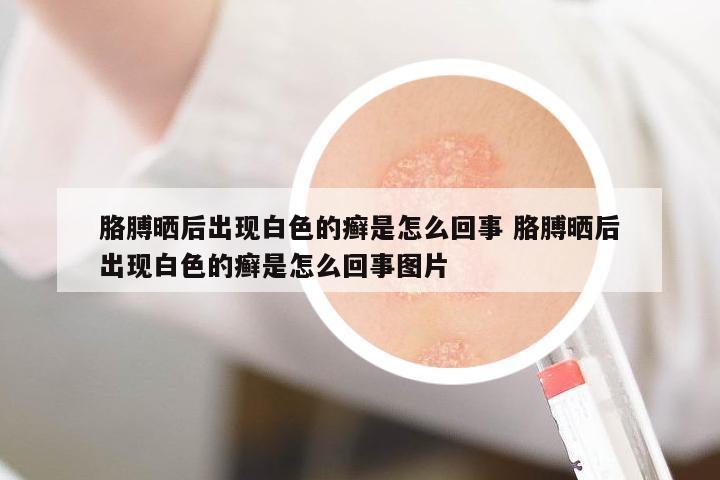 胳膊曬后出現(xiàn)白色的癬是怎么回事 胳膊曬后出現(xiàn)白色的癬是怎么回事圖片