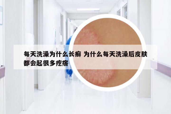 每天洗澡為什么長癬 為什么每天洗澡后皮膚都會起很多疙瘩