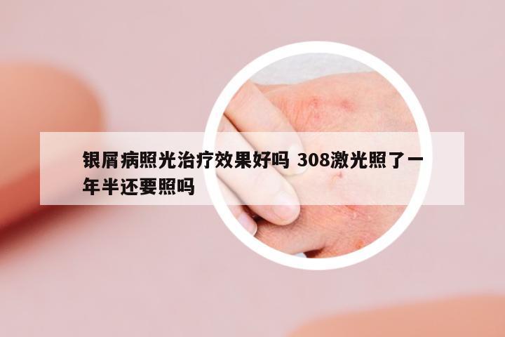 銀屑病照光治療效果好嗎 308激光照了一年半還要照嗎