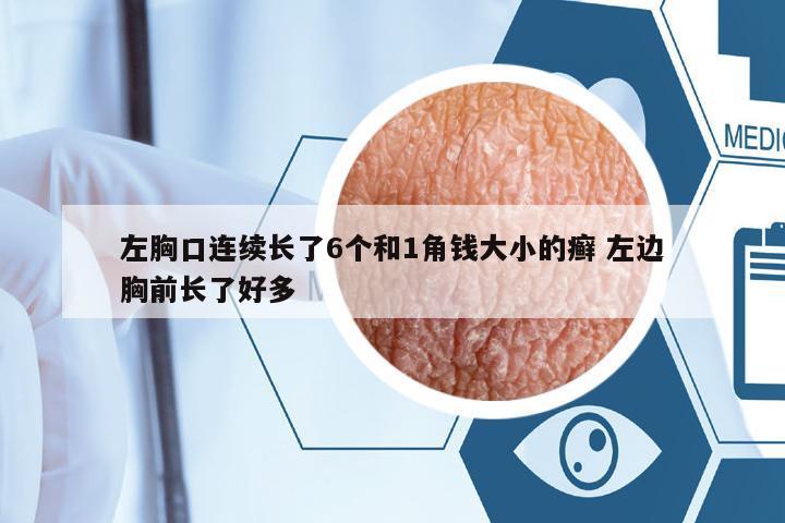 左胸口連續(xù)長(zhǎng)了6個(gè)和1角錢大小的癬 左邊胸前長(zhǎng)了好多