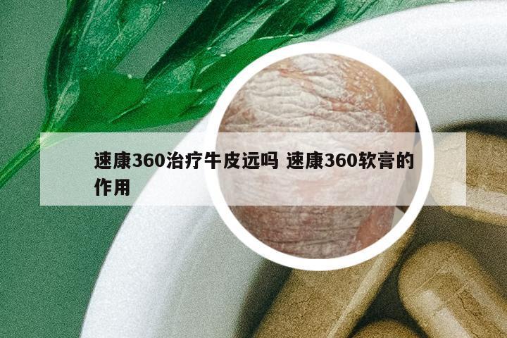 速康360治療牛皮遠嗎 速康360軟膏的作用