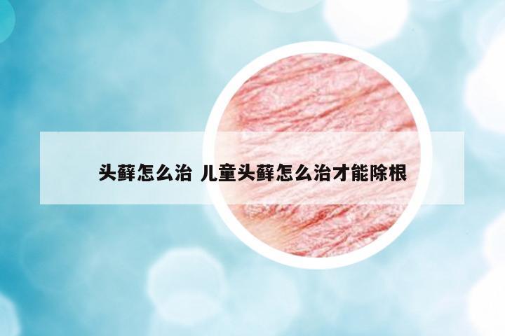 頭蘚怎么治 兒童頭蘚怎么治才能除根