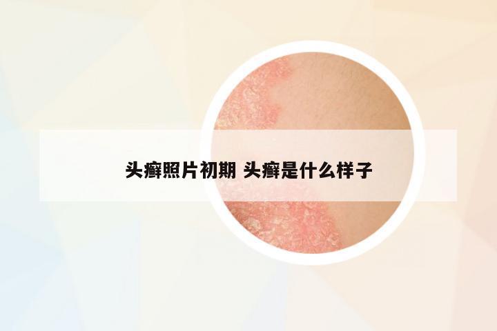 頭癬照片初期 頭癬是什么樣子