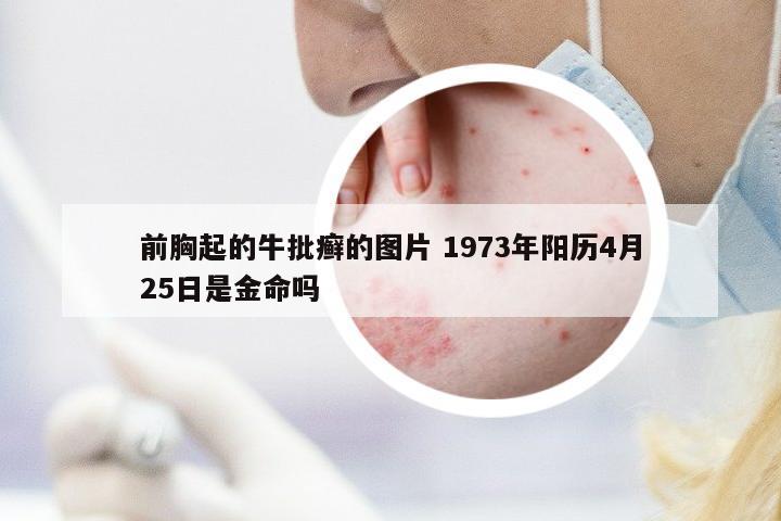 前胸起的牛批癬的圖片 1973年陽歷4月25日是金命嗎