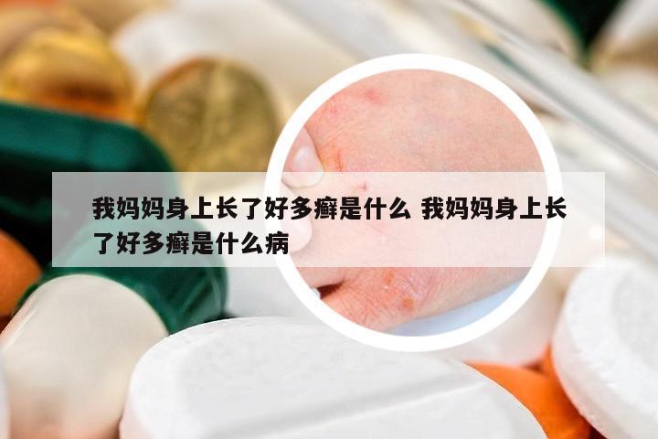 我媽媽身上長(zhǎng)了好多癬是什么 我媽媽身上長(zhǎng)了好多癬是什么病