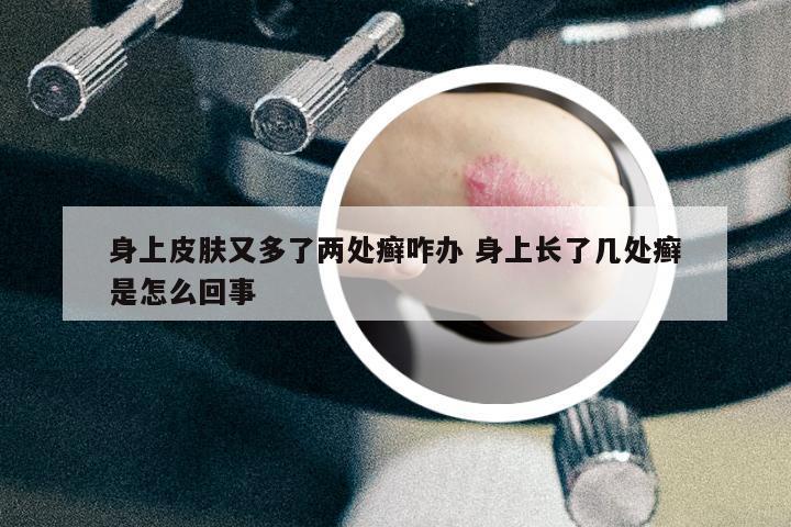 身上皮膚又多了兩處癬咋辦 身上長了幾處癬是怎么回事