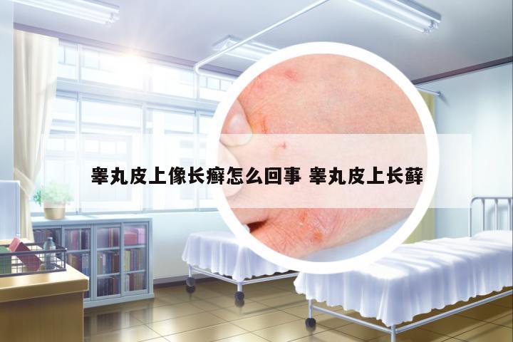 睪丸皮上像長癬怎么回事 睪丸皮上長蘚